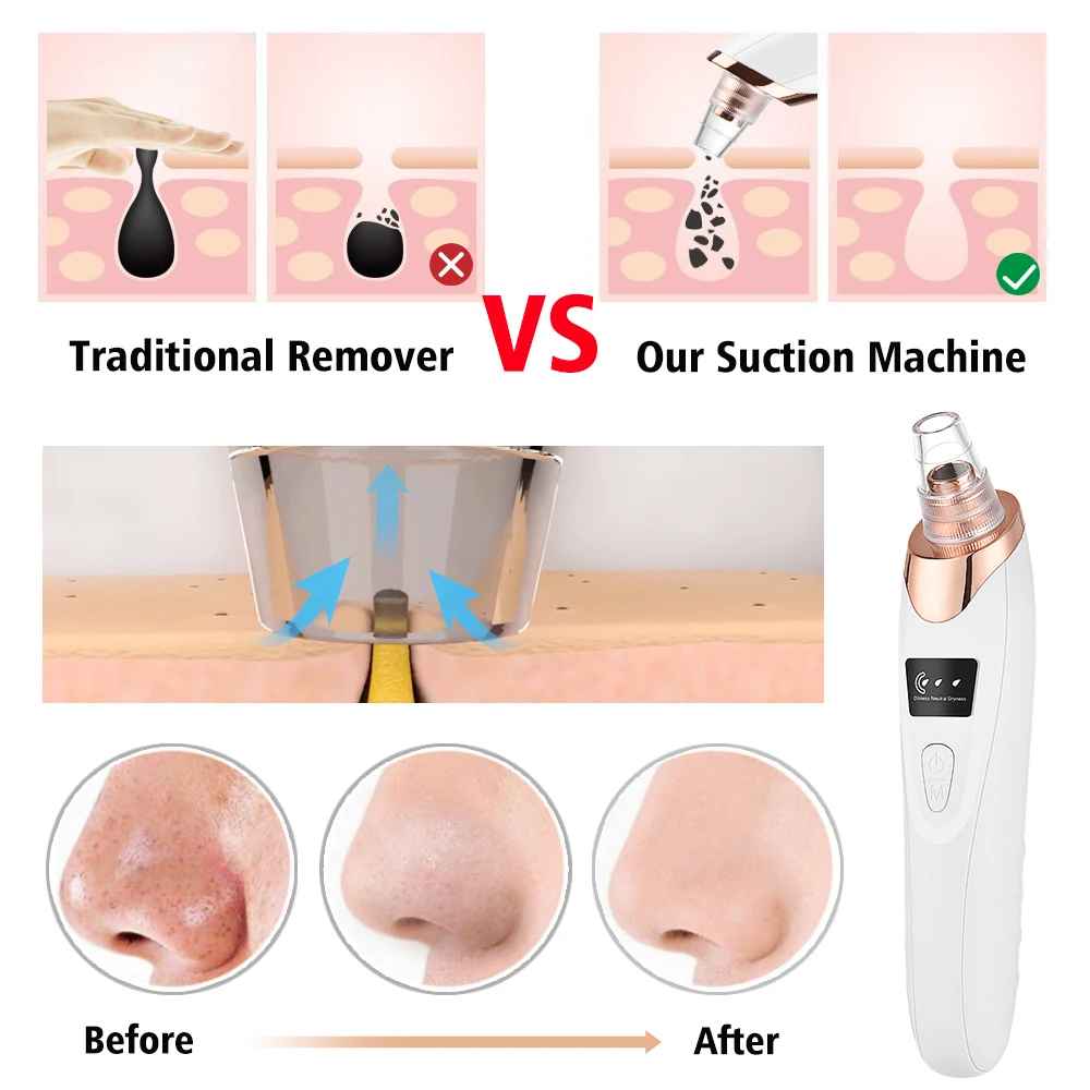 SkinVac™ Facial Pore Vacuum – Gentle, Powerful & Portable Skincare Tool