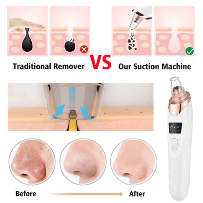 SkinVac™ Facial Pore Vacuum – Gentle, Powerful & Portable Skincare Tool